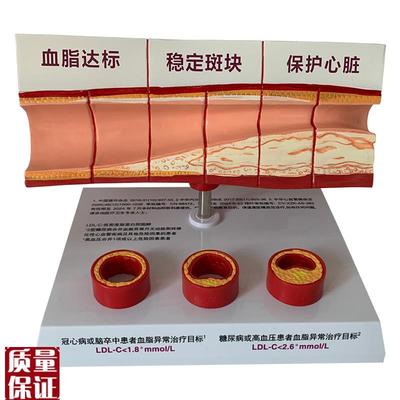 血管活动堵塞动i支脉粥样硬化心血管动脉硬化模型血管病理模型血