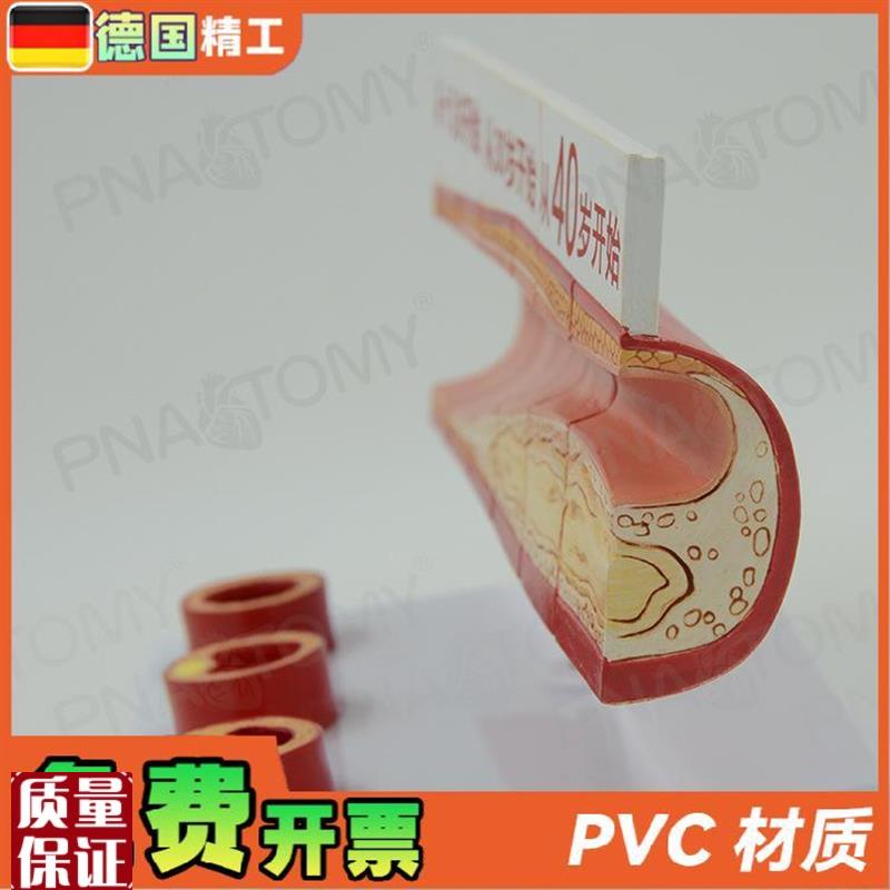 德国】人体血脂胆l固醇与年龄模型guan心病血栓过程模动脉医