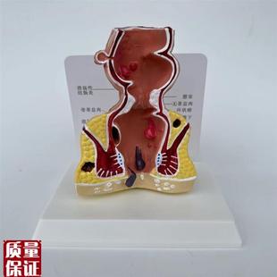 人体直肠模型g肛管裂开痔内外突出瘘管消化道结肠大肠医患病理沟