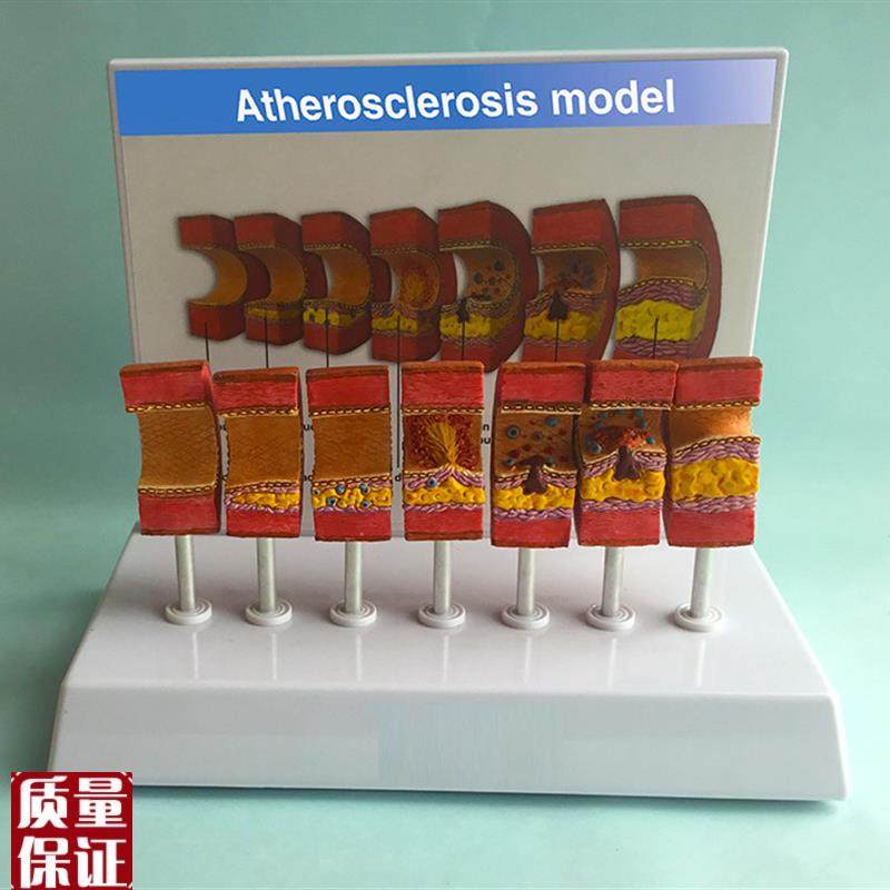 血管模型a动脉粥样硬化模型血栓栓塞模型血脂血管堵塞厂家直