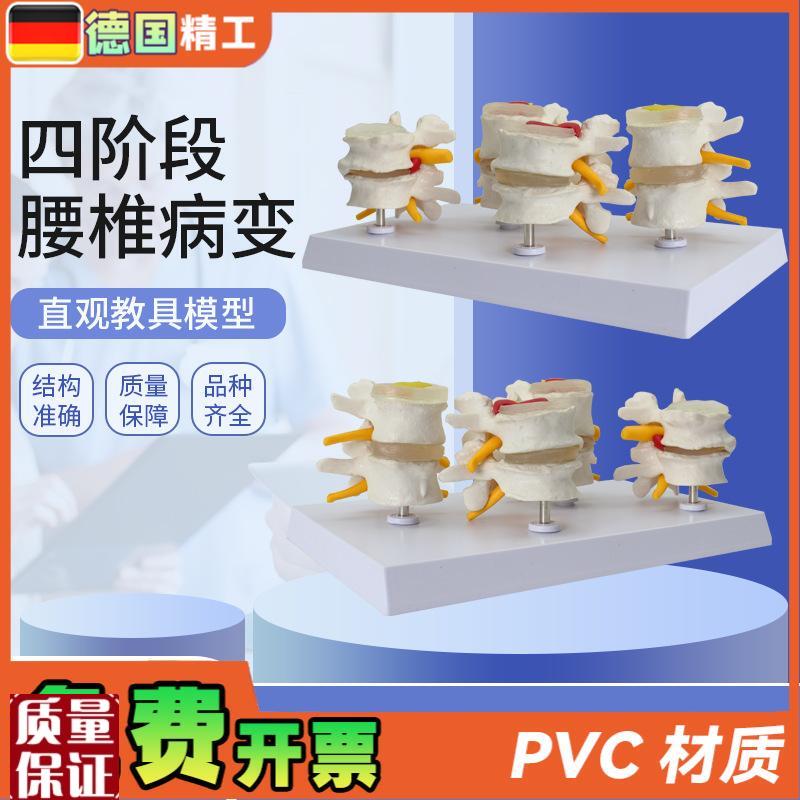 德国】人体腰椎模型四阶段腰椎对比椎间盘突出U脱出演示模型骨