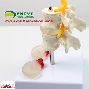 ENOVO颐诺人体腰椎椎间盘x突出模型骨骼脊柱脊椎骨科模型骨科科中