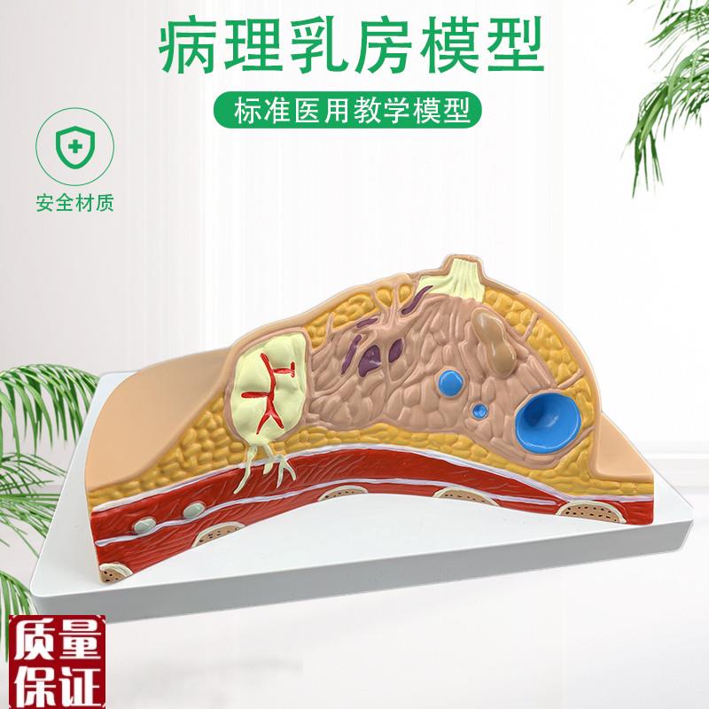 乳腺病变模型乳房模型乳房病变模型解剖模Q型医用人体组织模