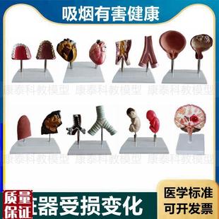 心脏模型病理正常对比吸烟有害心血管H肺气管口腔牙齿戒烟警示教