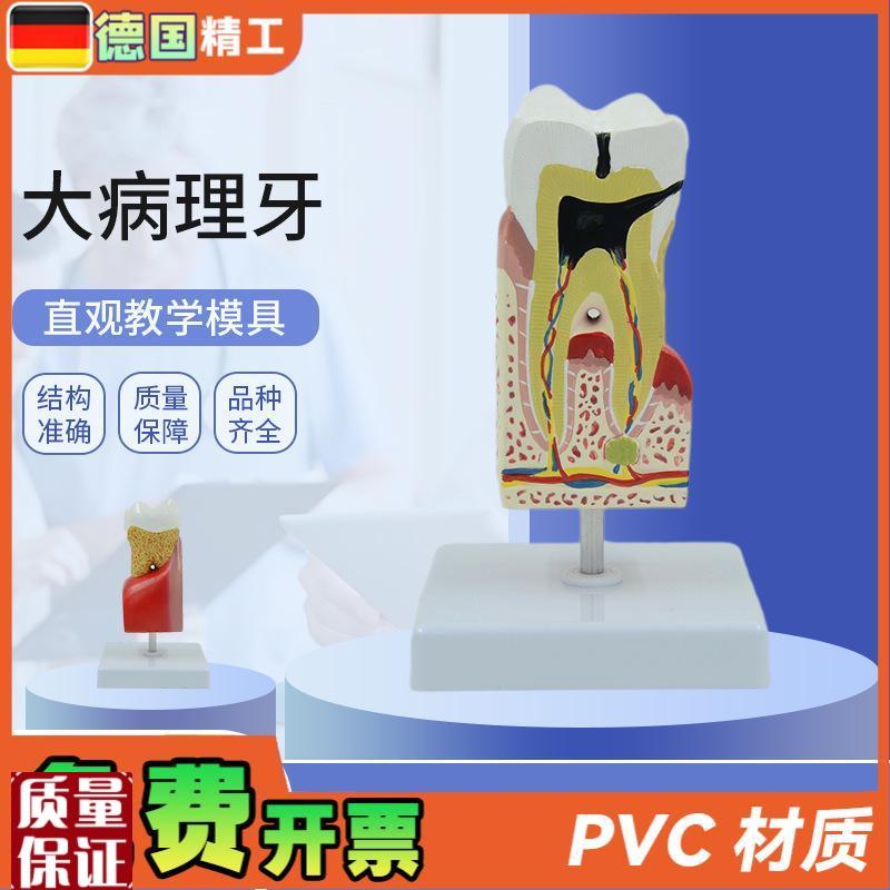 德国】人体大病理牙齿模型蛀牙模F型蛀牙放大牙齿解剖病理牙