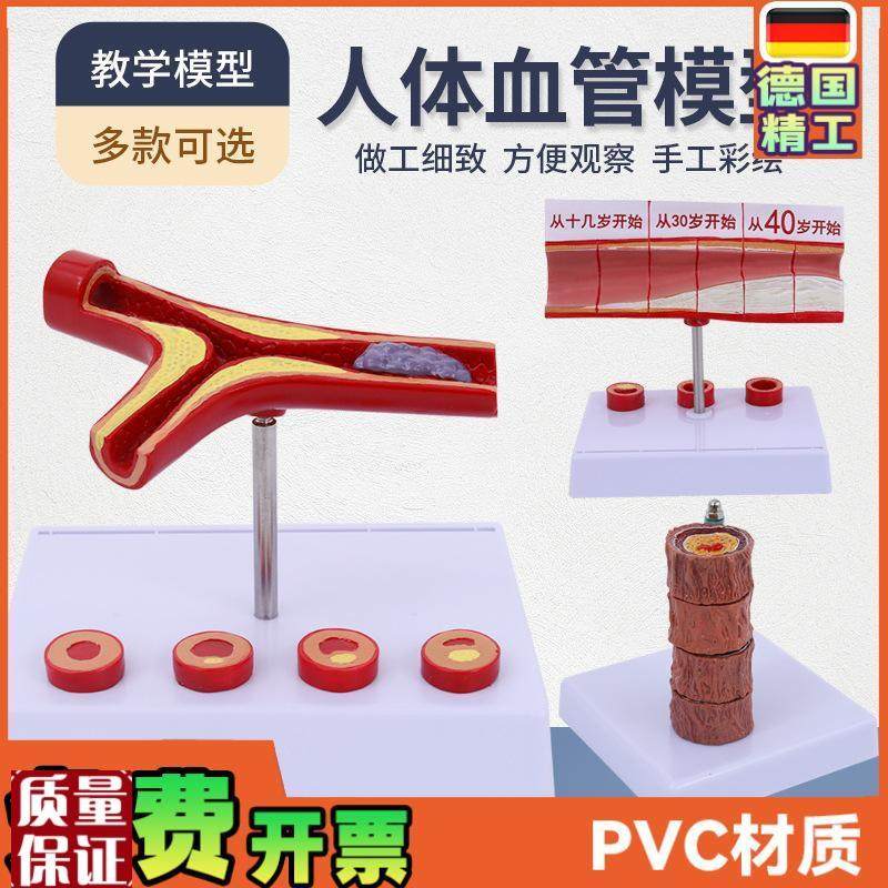 堵塞心血管e模型血栓血液浓度脂肪病理粥样硬化人体血管解剖模