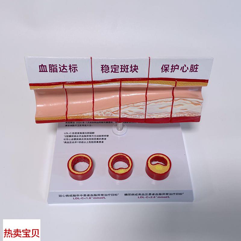病理心血管模型粥样硬化脂肪斑块动脉H内膜受损程度医药促销礼品
