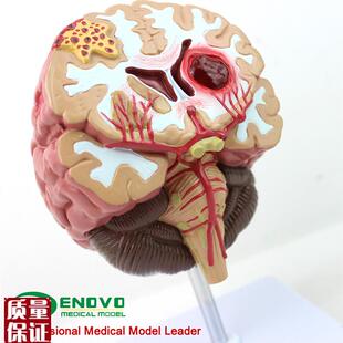 颐诺正品医用人体脑部疾病模型C大脑模型神经外科神经内科模