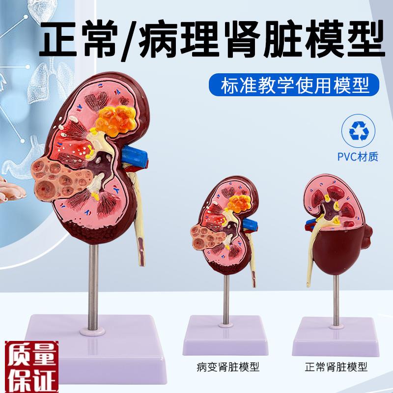人体肾解剖模型病变肾脏模z型肾脏模型人体内脏器官解剖模