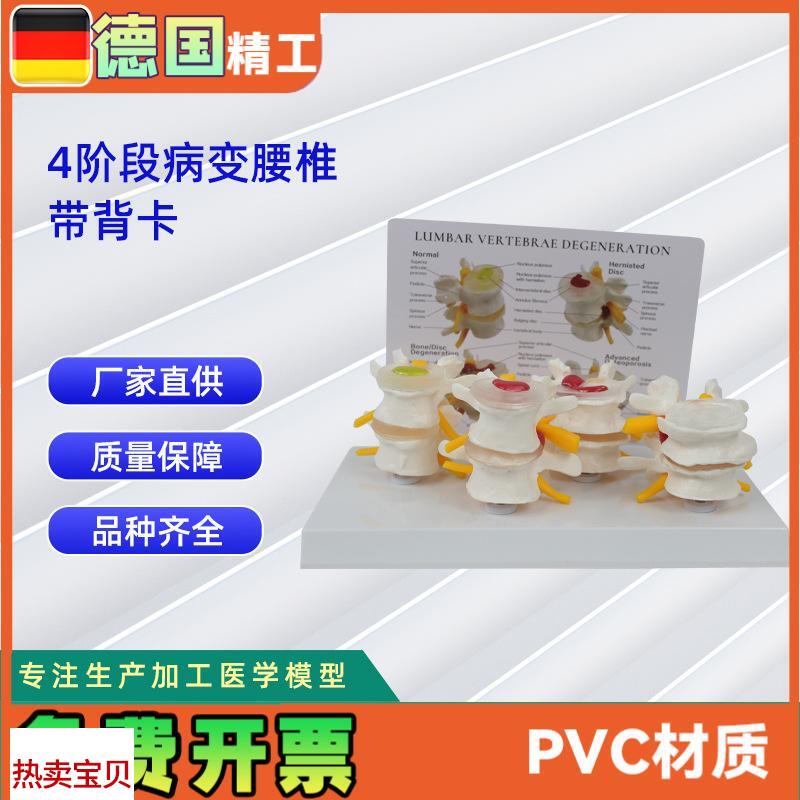 4阶段病态腰椎比较模型带背卡骨科教.学展示教具