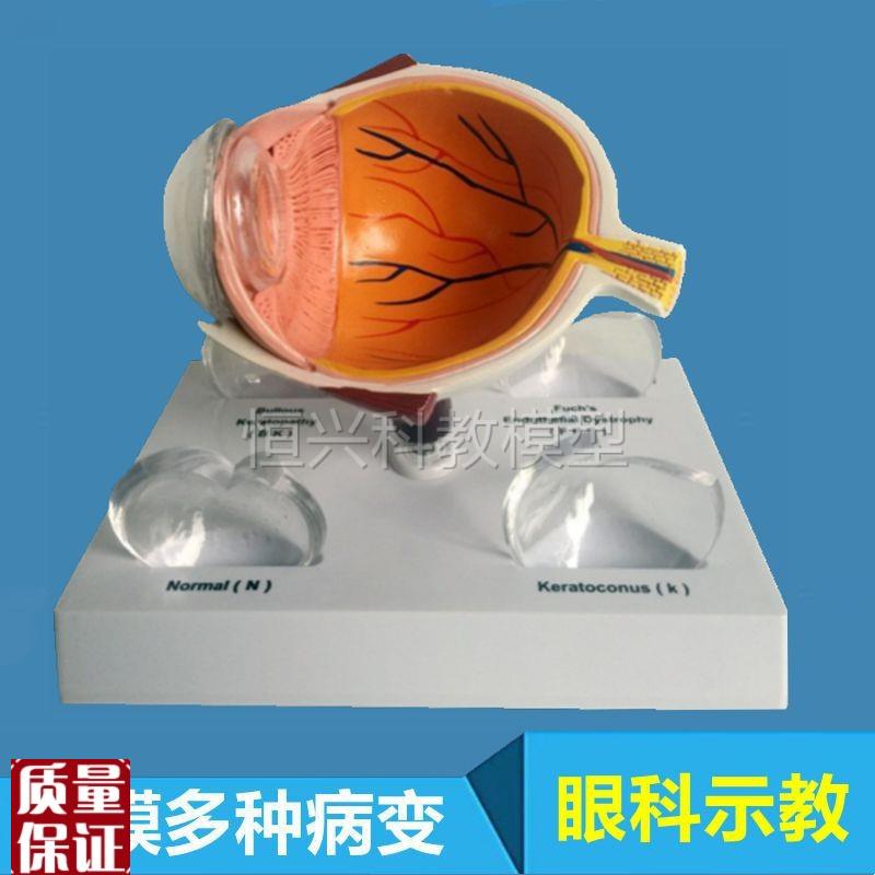 角膜模型常见病变视力模糊眼球结构视网膜眼底血T管视神经眼科医