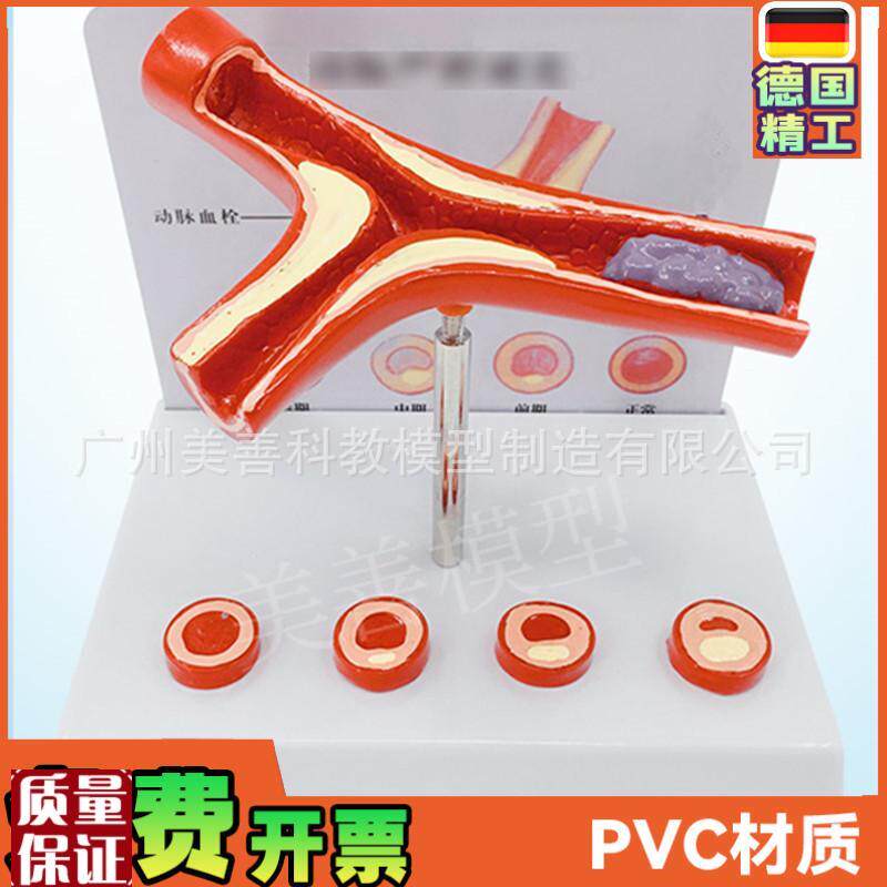 人体支脉粥样硬化人体q血管血管模型血管堵塞老年人血管病理模