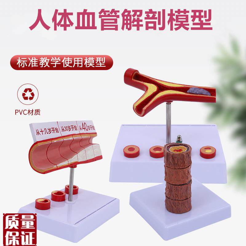 人体血管模c型粥样动脉/硬化模型病变血栓/血管/病演示血管模