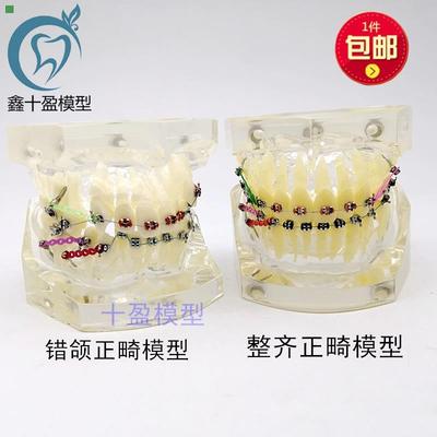 牙科正畸模型 透明错颌矫正展示模型 结扎丝托槽正畸带支抗钉牙列