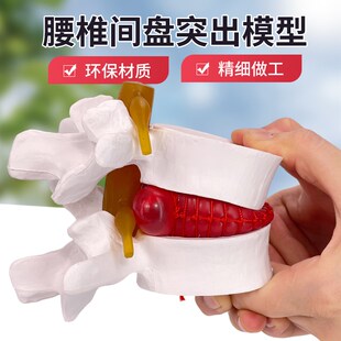 腰椎放大腰椎间盘受压演示模型人体脊柱脊椎骨病理椎X间盘膨出模