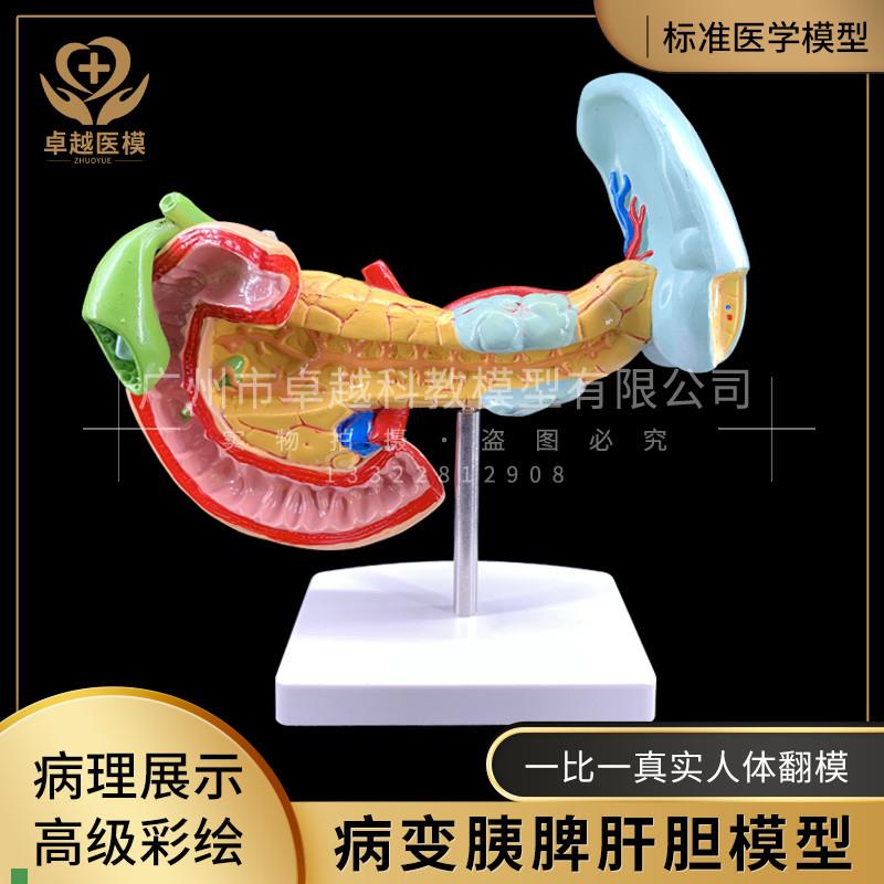 教学仿真病d变胰脾肝胆十二指肠模型病理胰腺标本胰脾肝胆解剖