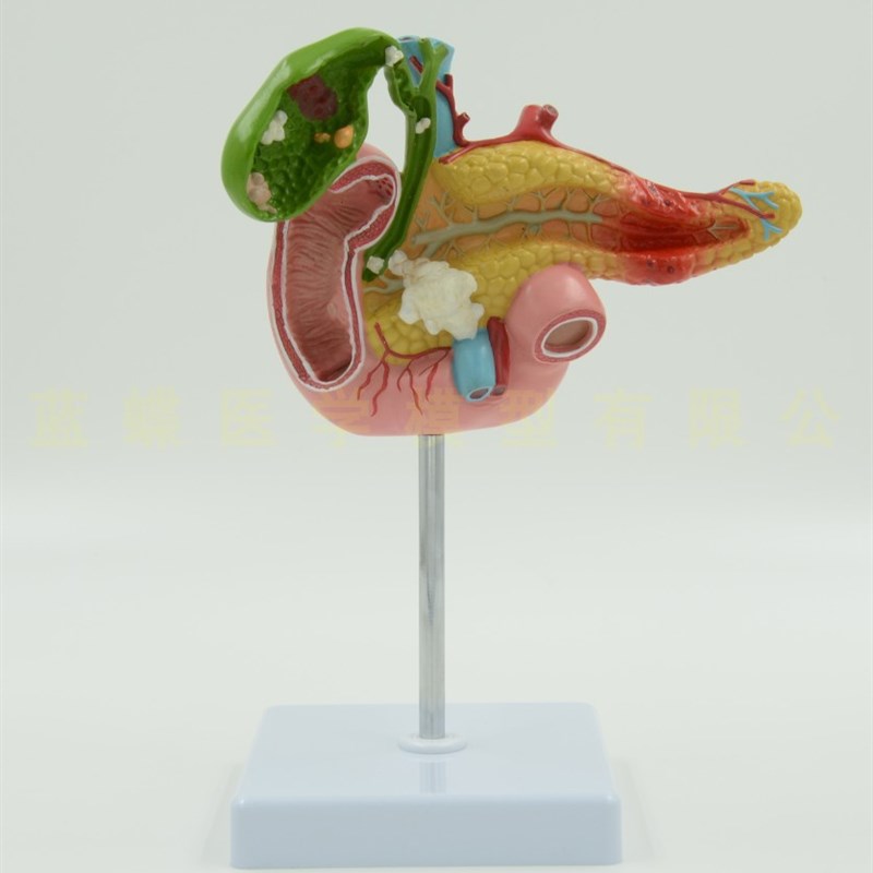 医学胰腺十二指肠胆囊病理模型 胆结石外科消化科U系统肝胆科模型