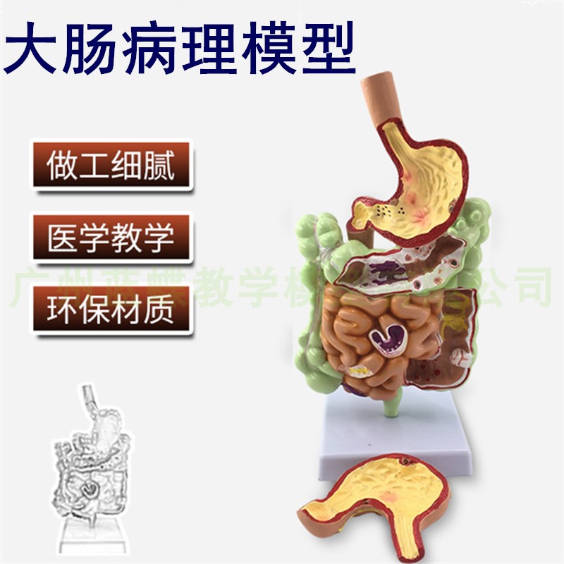 大肠病理模e型 肠胃模型 大肠病变模型 肠道疾病 人体结肠病变模