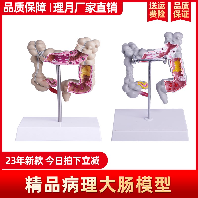 人体结肠病变e模型大肠病理模型大肠模型肠胃病变肠道疾病解剖模