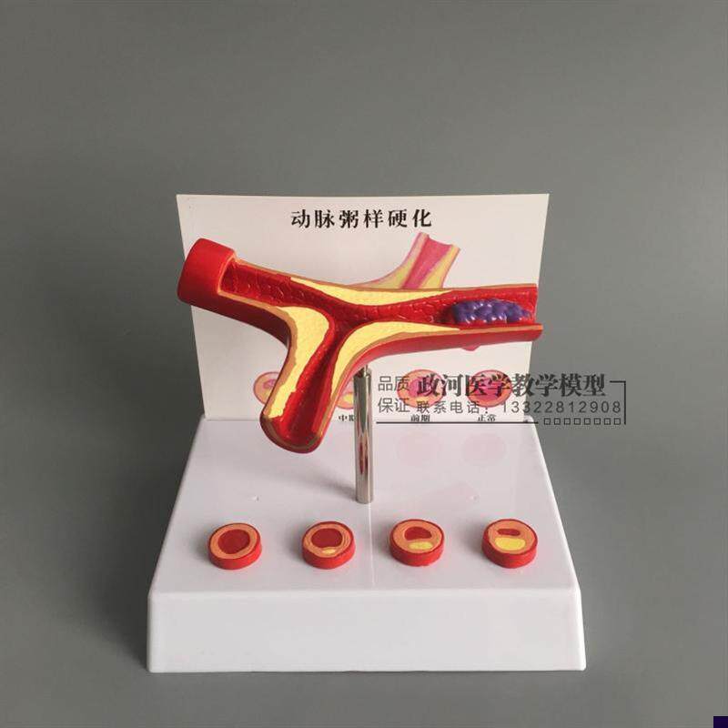 冠状动脉性心血管动脉s硬化模型 老年心脏模型血栓形成