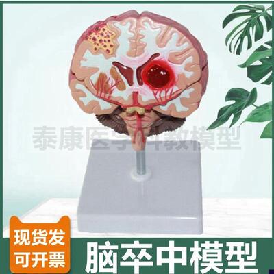 病理脑模型卒中破裂脑室血管医患沟通H展示脑组织可拆卸功能区神