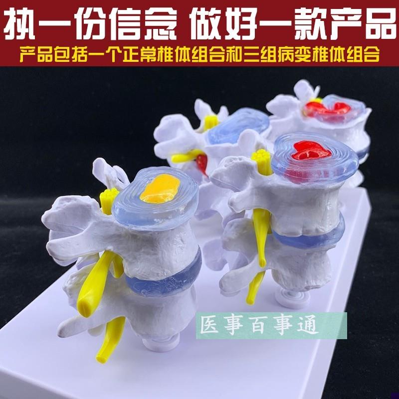 病理腰椎模型人体骨骼模型医院学校用H教学演示4对椎间盘脊椎摆件