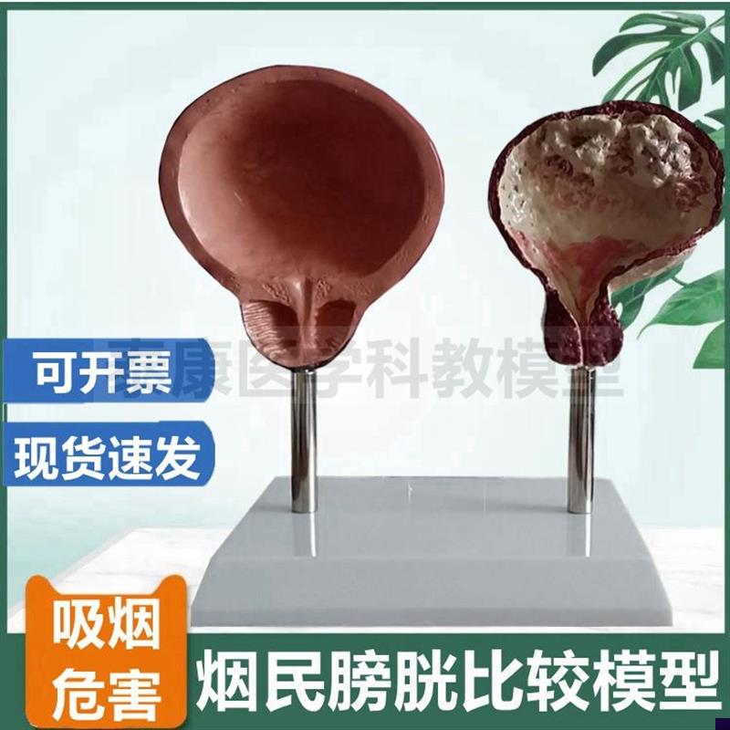 吸烟人的膀胱模型病理戒烟教育展示科普I医用健康讲座吸烟危害人