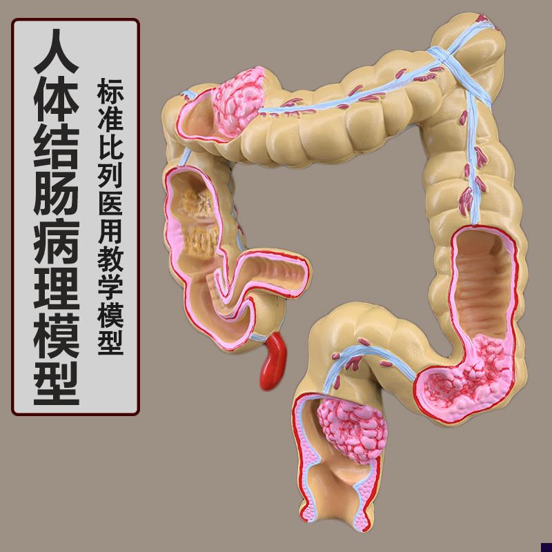 大肠病变病理解剖模型p肠道疾病人体结肠病变模型人体器官解剖模