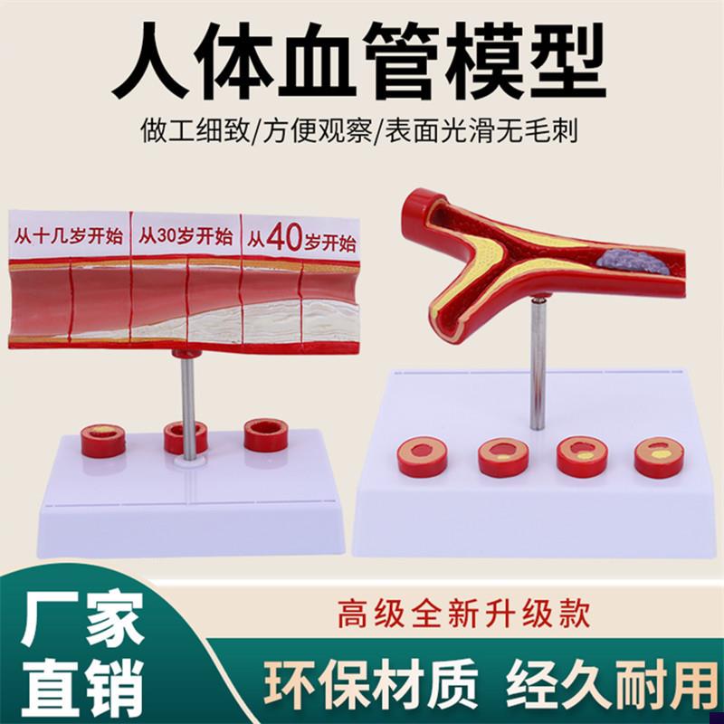 堵塞心血管模型关节血栓血液浓A度脂肪病理粥样硬化人体解剖教具