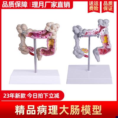人体结肠病变模型大肠病理模型大肠模型肠胃病变肠道疾Z病解剖模
