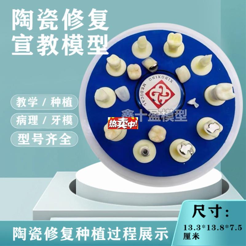 热销牙齿模型口腔教学陶瓷s10*1仿真修复治疗过程种植根管病理医