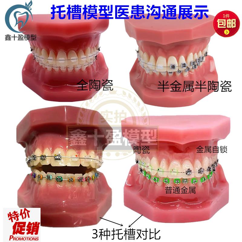 牙科正畸模型全口陶瓷金属自锁红色正畸医患沟T通矫正练习托槽