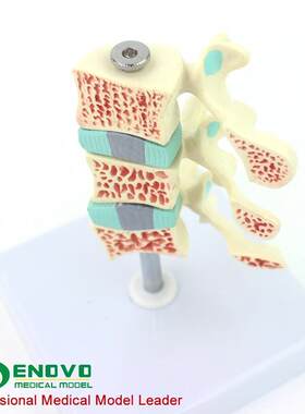 ENOVO颐诺人体骨质疏松症模型关节骨质疏松模型人体X椎间盘腰椎模