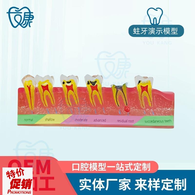 口腔教学模d型牙科口腔牙科蛀牙模型蛀牙演示模型蛀牙龋齿模型