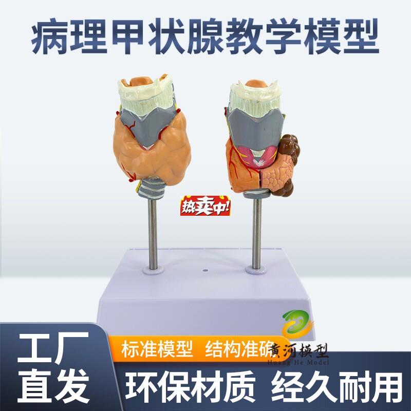 热销教学仿真l人体甲状腺病理模型甲亢模型病态甲状腺模型甲状腺