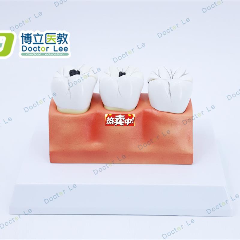 热销教学彷真龋齿模型牙齿模型病变牙齿模型3颗龋g齿模型龋齿分解