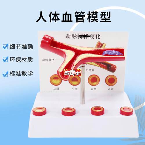 热销血管病理粥样硬化动脉模K型病变血栓模型人体病态血管演示放