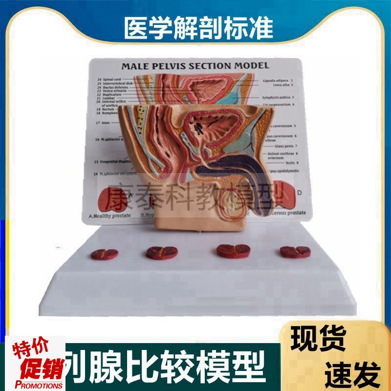 男性盆腔模型泌尿生o殖前列腺病变比较医患教育膀胱直肠肛门尿道