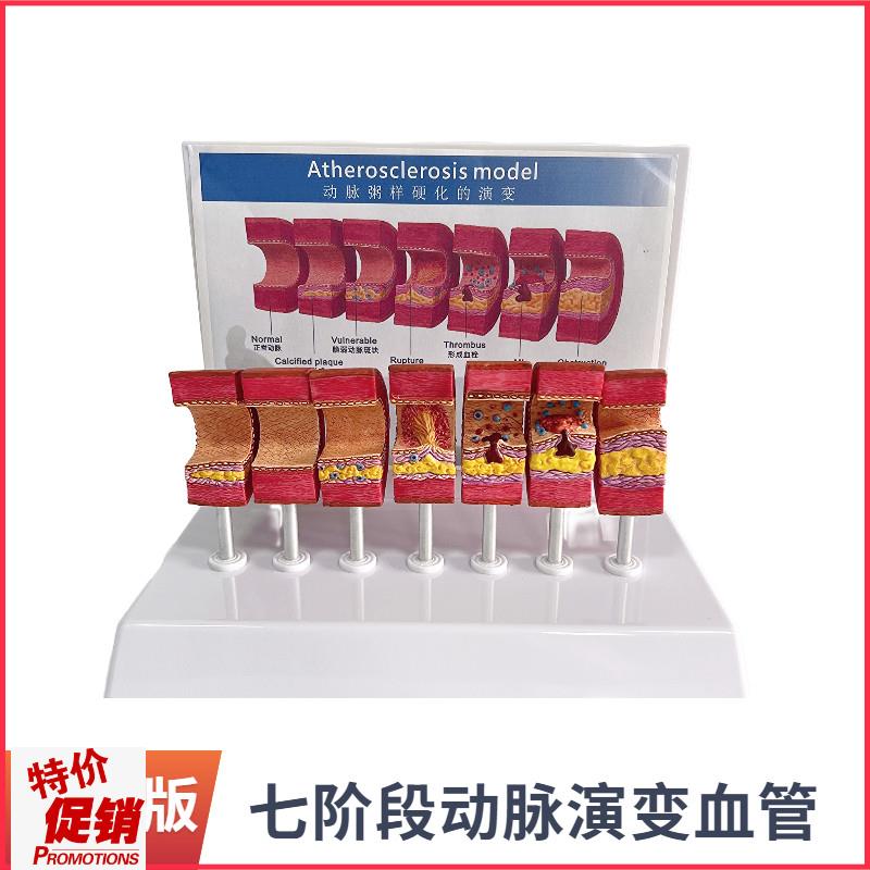 动脉粥样硬化模型血管血栓栓塞模型动脉血管人Q体医用医学教学教