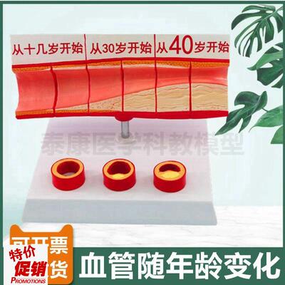 中老年人血管模型k内膜受损粥样斑块栓子硬化阻塞管腔狭窄心血管