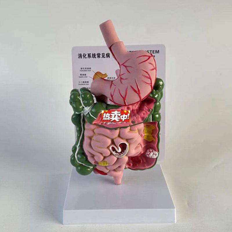热销康泰医用模型食管胃肠道病变桌上型医患示教u消化道医药促销