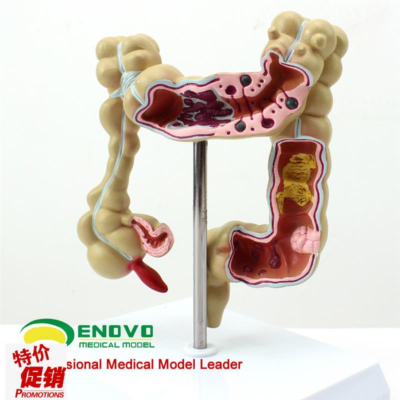 颐诺正品人体结肠病变模型肛肠科消化科大肠Q模型医用人体解剖