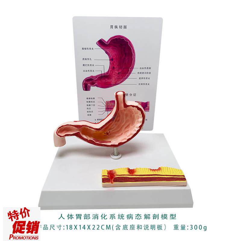 胃病态结构模型萎缩胃炎溃疡穿孔人体消化系P统模型人体解剖教具