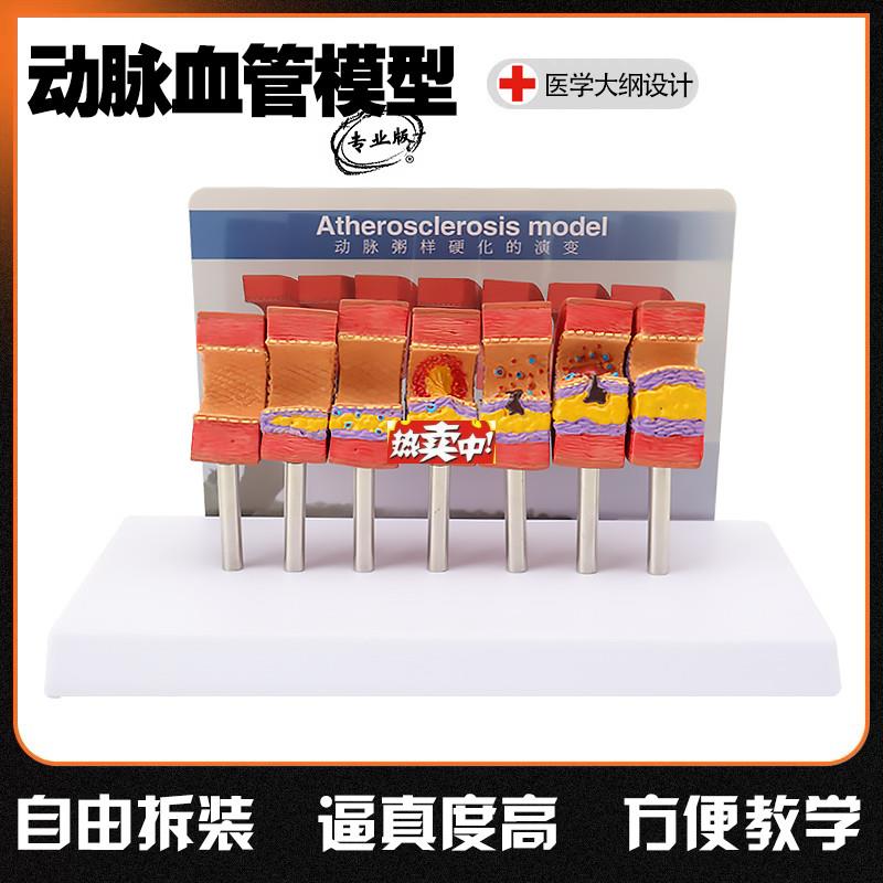 热销人体血管病O理解剖模型人体血管结构模型血液浓度脂肪病理血