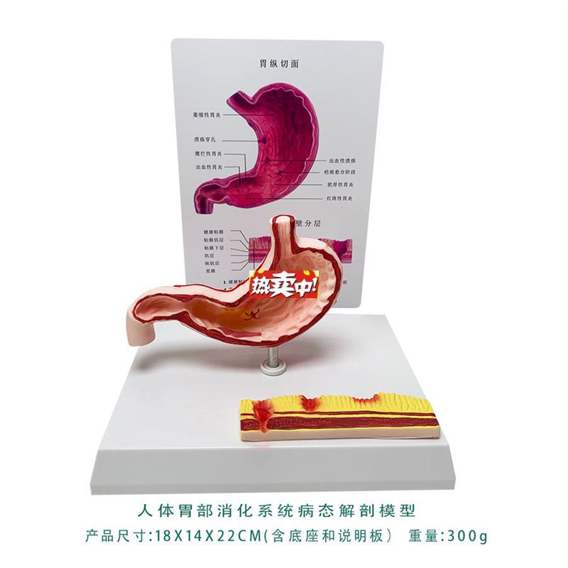 热销胃病态结构模型萎缩胃炎溃疡穿o孔人体消化系统模型人体解剖
