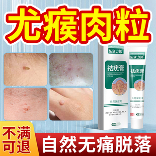 去尤瘊小肉粒神器扁平疣去除膏一抹灵无忧药膏祛脖子上长疣瘊工具