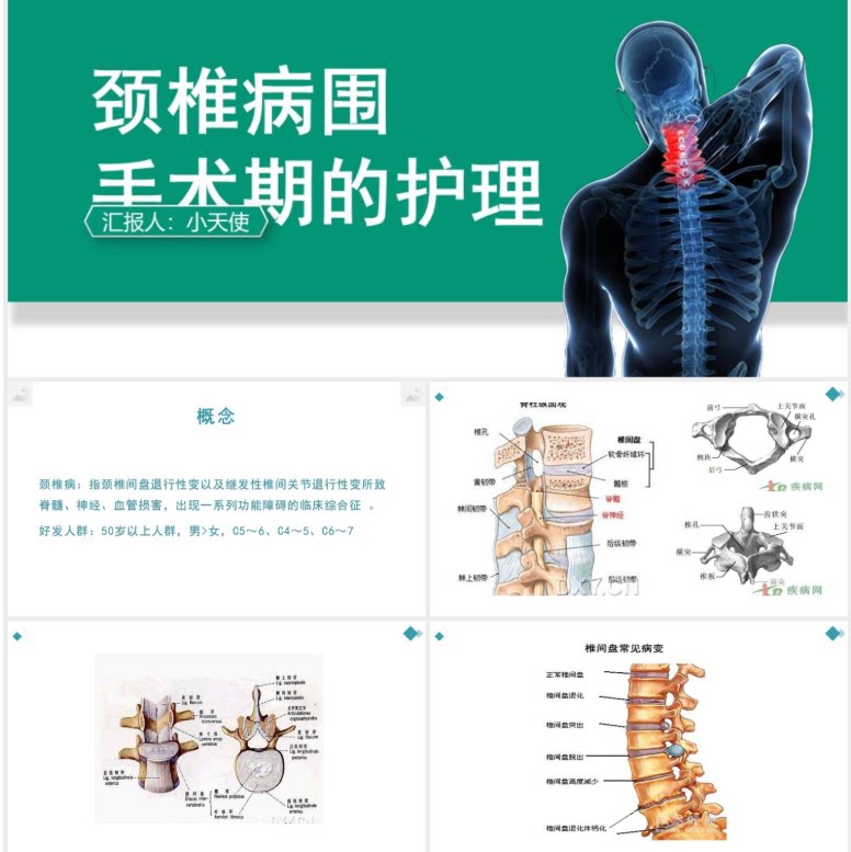 蓝色颈椎病围手术期的护理查房治疗PPT