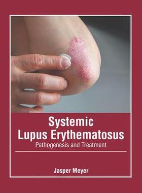 [预订]Systemic Lupus Erythematosus: Pathogenesis and Treatment 9781639272136