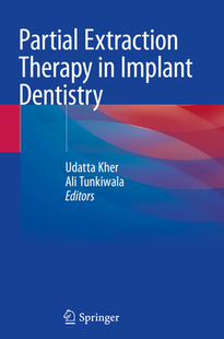 Partial Implant Extraction Dentistry Therapy 预订