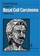 Basal Cell Face Surgery the Carcinoma